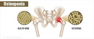 Healthy vs osteopenia bone comparison.