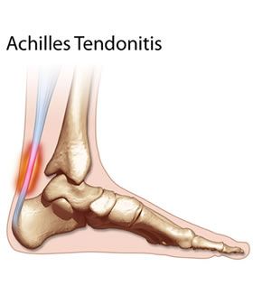 Achilles Tendonitis illustration.