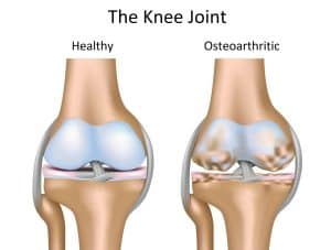 healthy and osteoarthritic knee joint