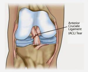 Anterior Cruciate Ligament (ACL) tear.