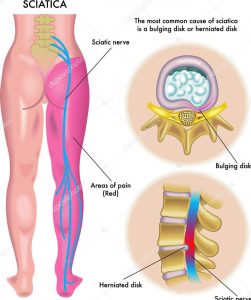 Sciatica pain relief at Singapore Physio.