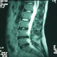 MRI scan of the lumbar spine at Spine &P.