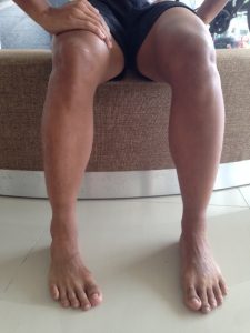 Person with knee pain at Singapore Phys.