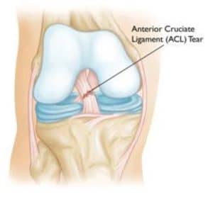 ACL tear illustration at Singapore Phys.