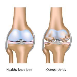 Healthy knee joint vs osteoarthritis.