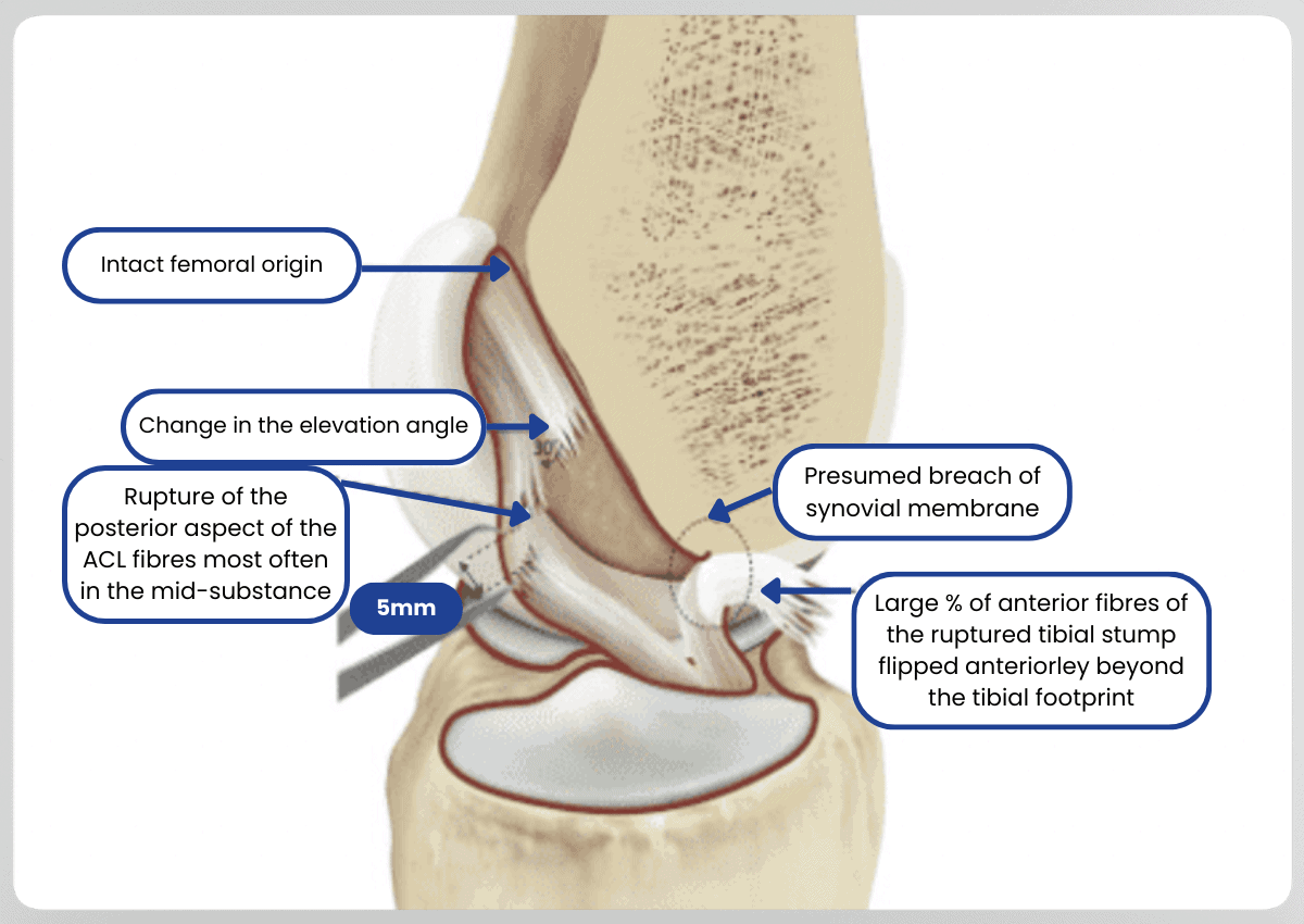 Knee anatomy with ACL injury details.