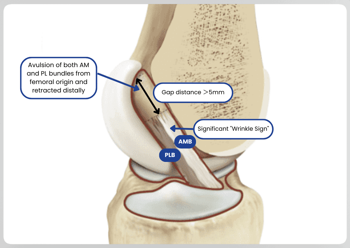 Knee ligament injury diagram with labels.