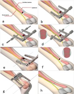 Surgical procedure for Achilles tendon.