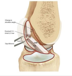 Type 1 ACL Injury
