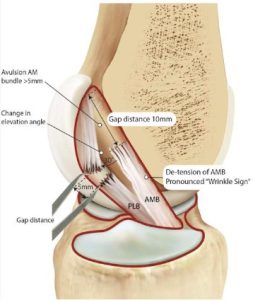 ACL Tear Types Classification