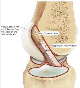 Knee joint with ACL injury signs and gap.
