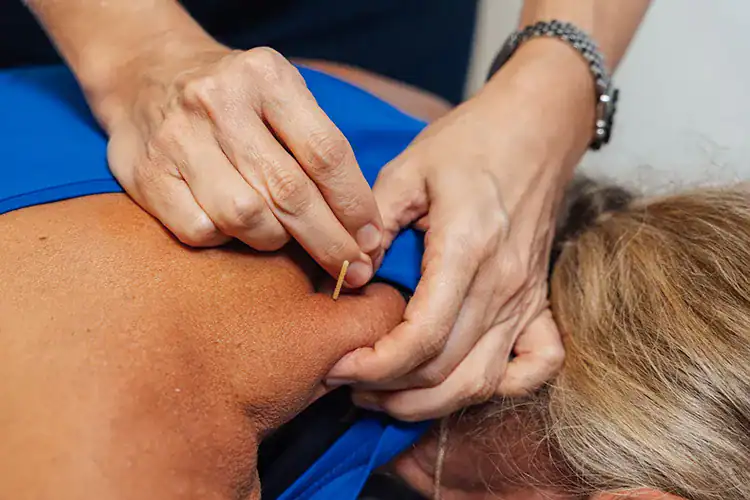 Dry needling treatment at Singapore Phys.
