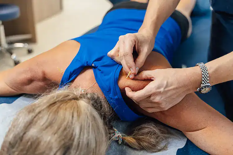 Physiotherapist performing dry needling.